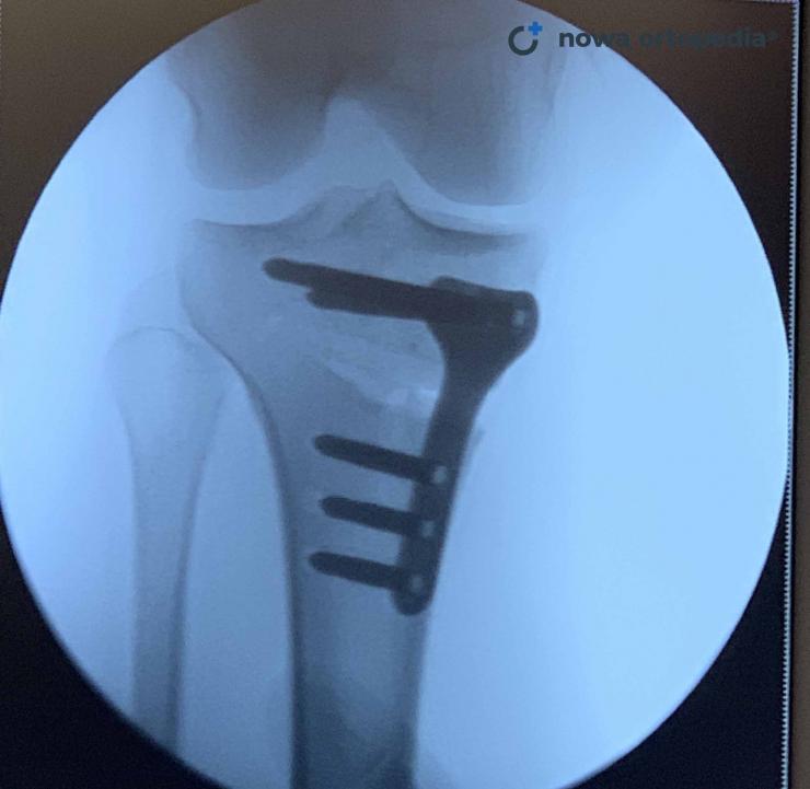 osteo5