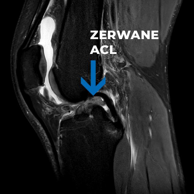 zerwaneacl